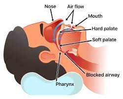 راه های درمان آپنه خواب